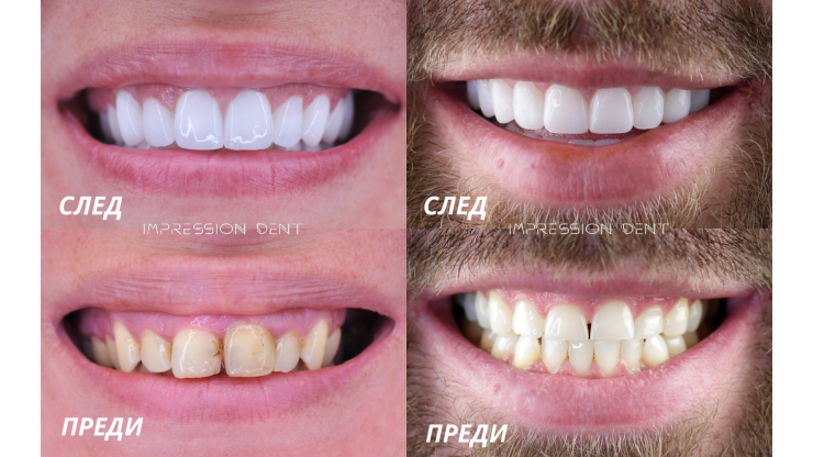 Снимка: Impression Dent